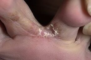 kërpudhat e lëkurës midis gishtërinjve
