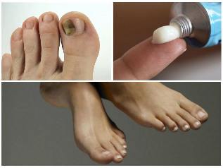kërpudhat e toenails trajtimi