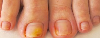 kërpudhat toenails simptomat