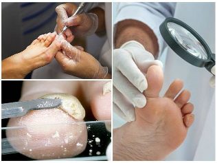 kërpudhat këmbë lëkurës diagnozë